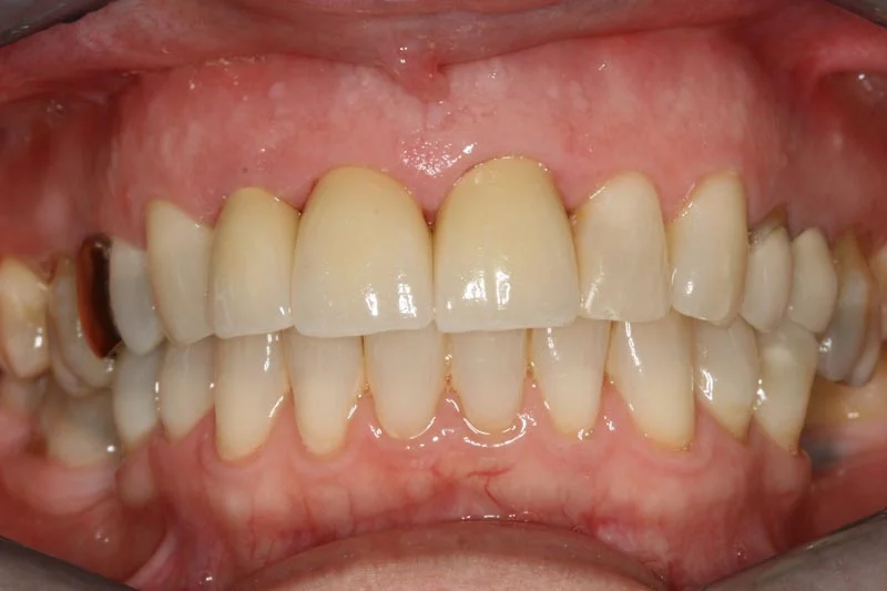 Fixing failing dental crowns - After