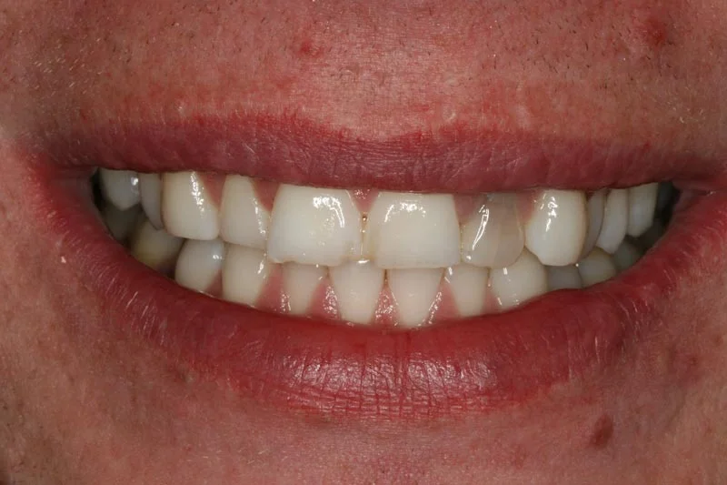 Fixing worn teeth - Before
