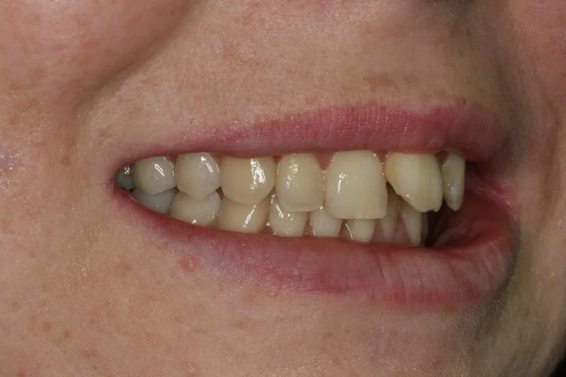 Sticking out teeth - Before