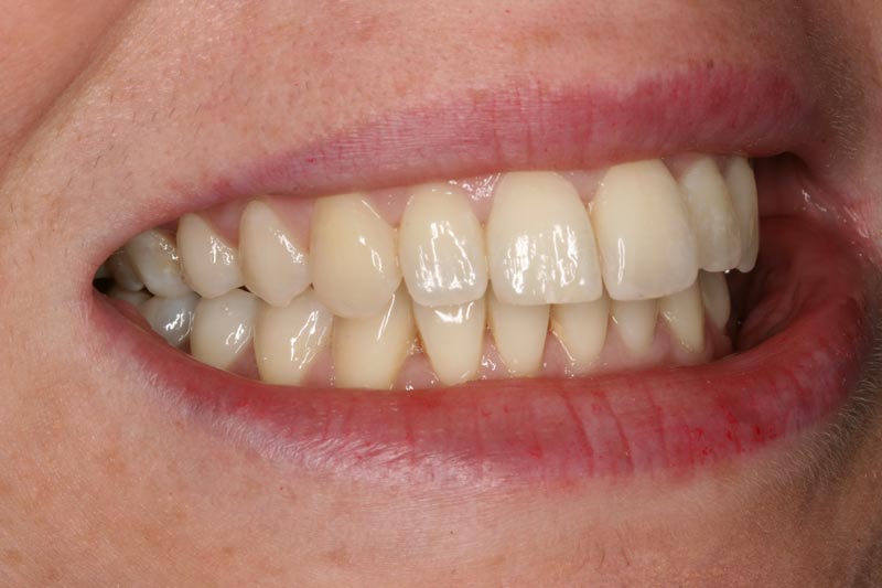 Sticking out teeth - After