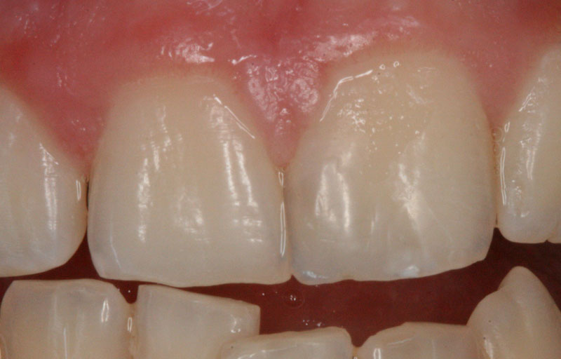 Broken Tooth - After