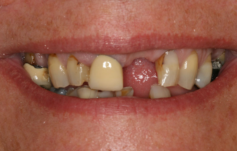 Problem teeth & denture - Before
