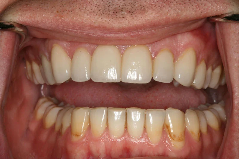 Gum marks and wearing teeth - After