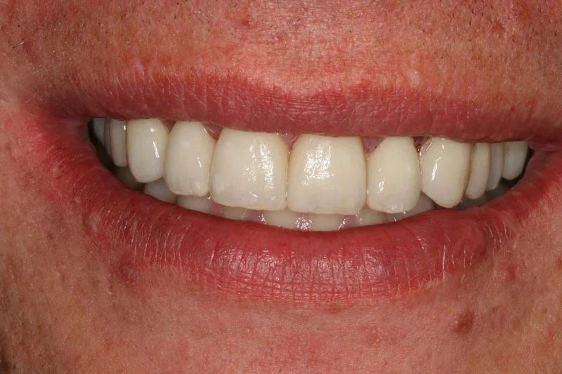 Fixing worn teeth - After