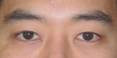  Before