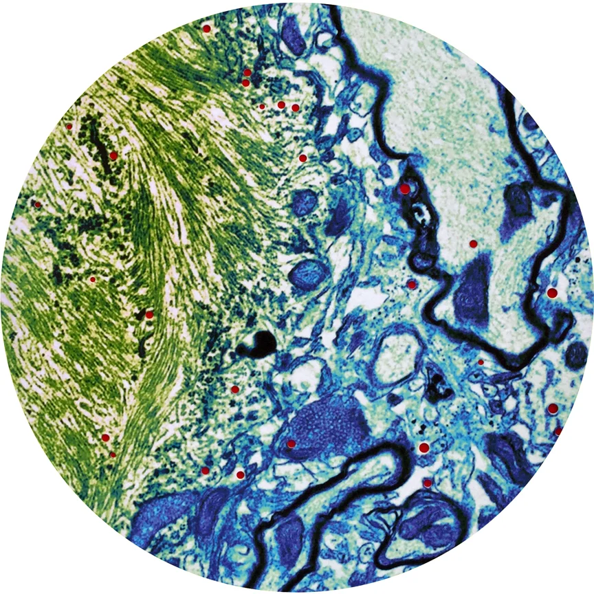 Plaque Biopsy, detail 2015