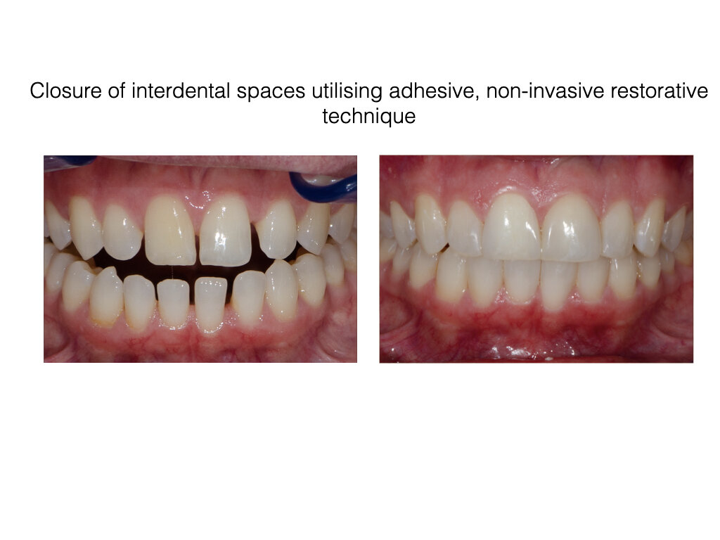 Closure of interdental spaces.003.jpeg