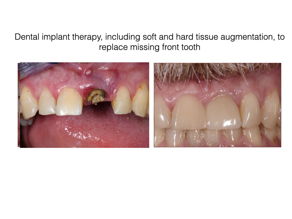 Dental implant therapy.003.jpeg