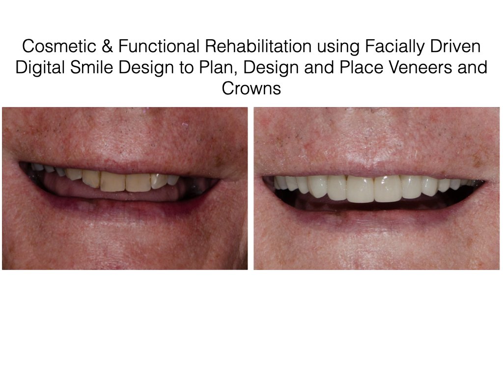 Cosmetic & Functional Rehabilitation using Facially Driven Digital Smile Design to Plan, Design and Place Veneers and Crowns.001.jpeg