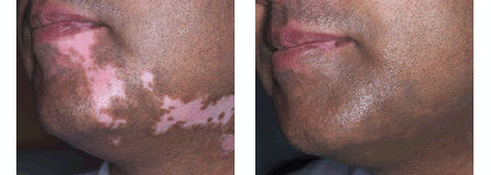 skincamouflage6.jpg