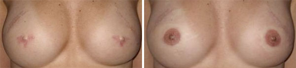 medical-tattooing-ba2.jpg