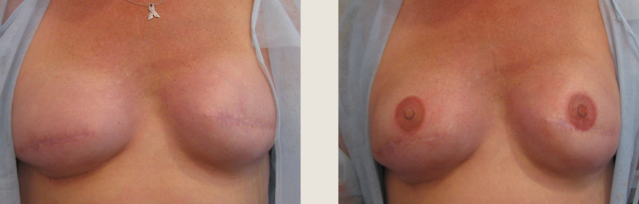 breast-tattoing-creating-areola-after-mastectomy-or-reconstruction-surgery-3L.jpg