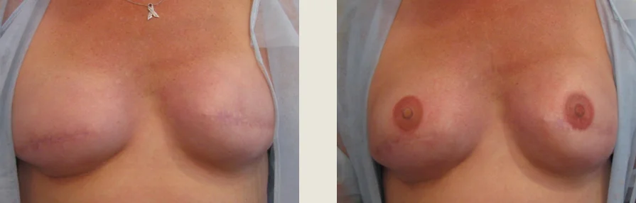 breast-tattoing-creating-areola-after-mastectomy-or-reconstruction-surgery-3L.jpg
