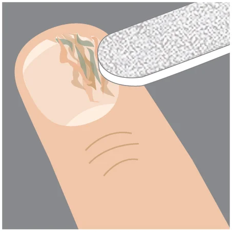 Step 1: File down the over-grown nail in order to fully penetrate into the treatment site.