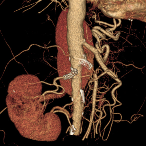 renal or peripheral computed tomography  (Copy)