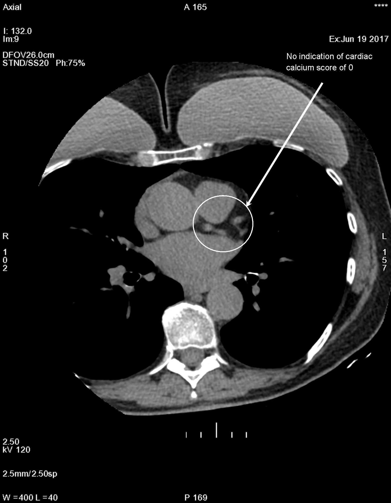 Cardiac Ct Scan _ Heart imaging: Benefits, risks, types, preparation ...