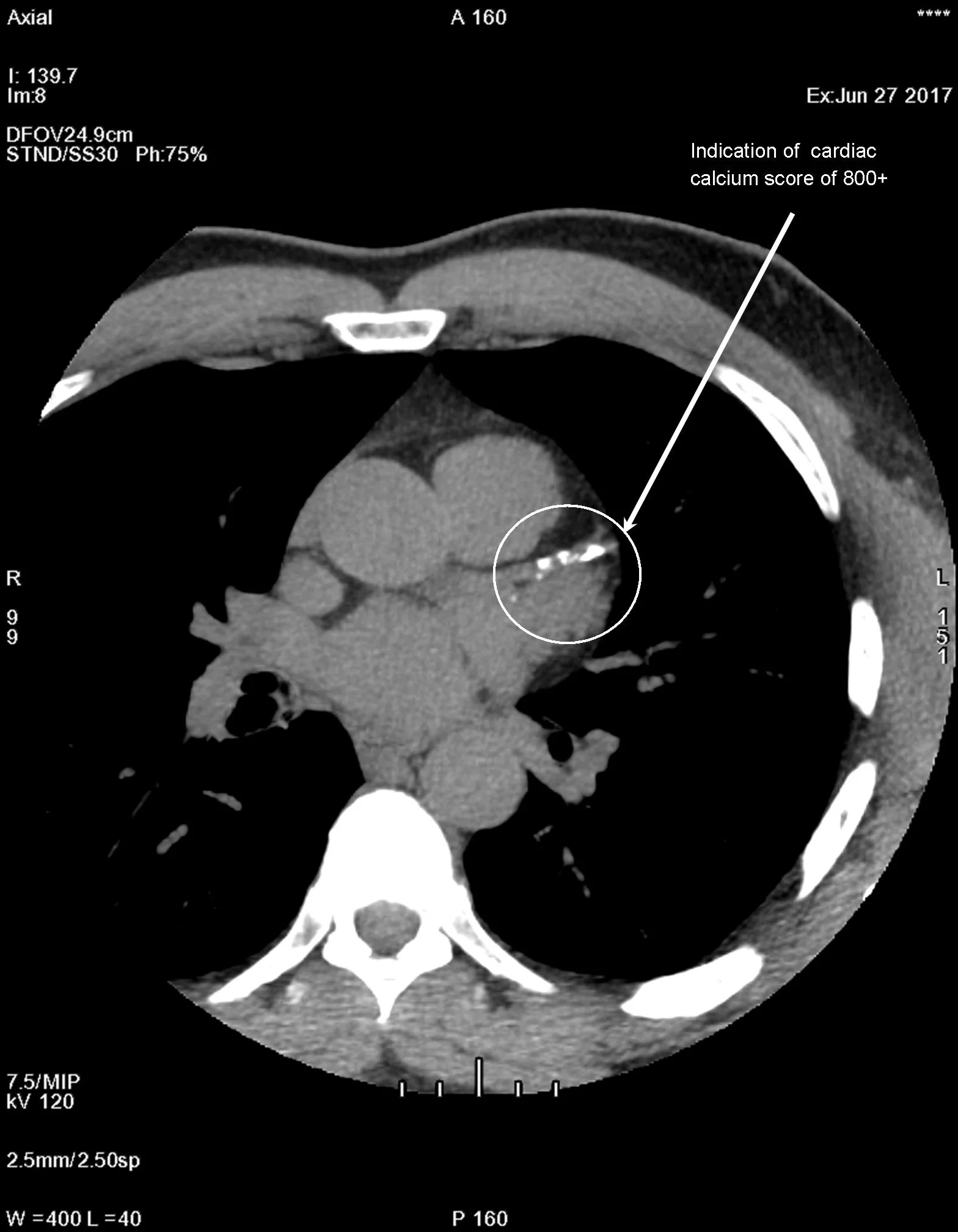 Coronary Arteries Calcium Score – LYIFAM
