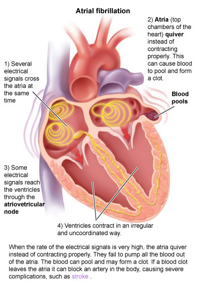 can high blood pressure cause afib