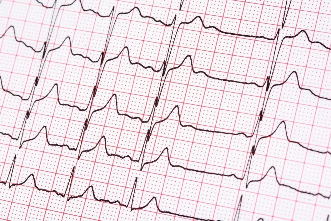  What is Atrial Fibrillation, Afib ?