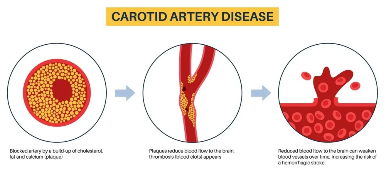 Carotid Stent: A Less Invasive Option to Treat Carotid Artery Disease and Help Lower Stroke Risk 