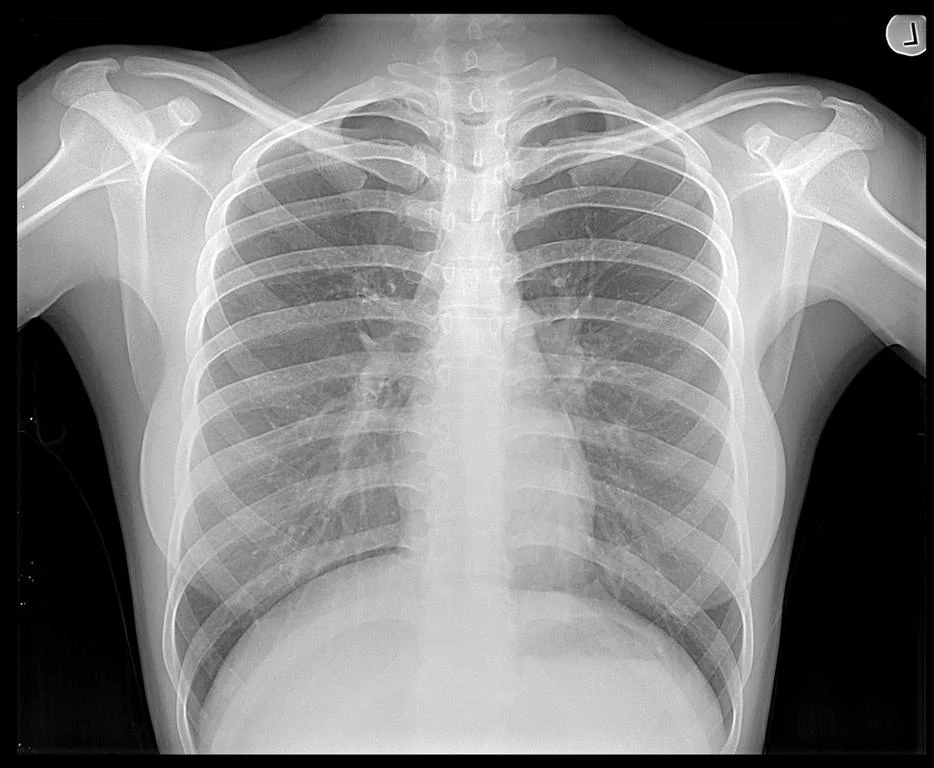 Chest-X-Ray-Image.jpg