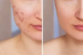 Bone Broth for Skin Health: A Natural Ally Against Acne, Eczema, and Psoriasis
