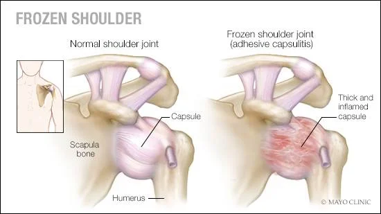 This is a look at your shoulder front the front.