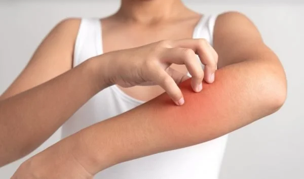 Hives-and-Itchy-Skin-at-Night-5-Ways-to-Ease-the-Itch-and-Sleep-Better-600x354.jpeg