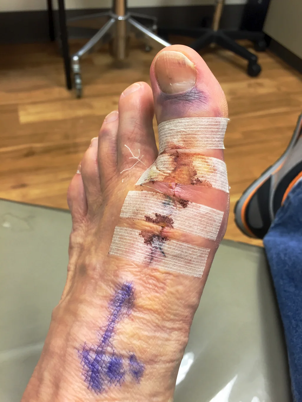 April left me with this big toe