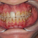Excessive Tooth Staining