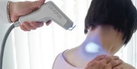 Cryofos treatment