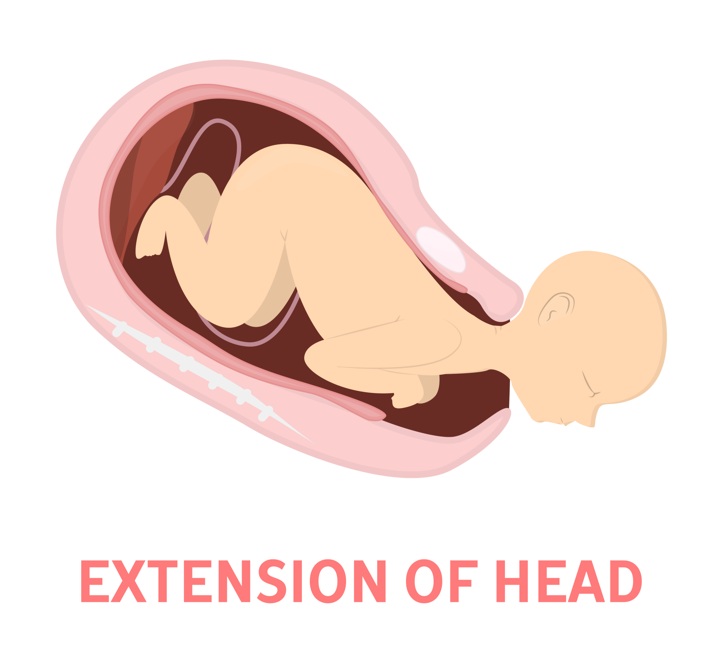 Extension.png