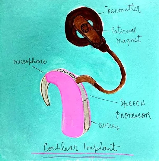 cochlearimplant.jpg
