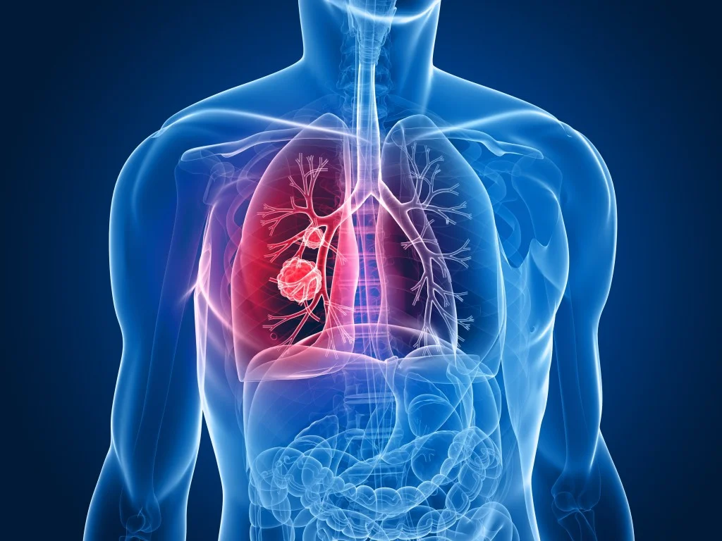 Diagram of lungs affected by Mesothelioma. 