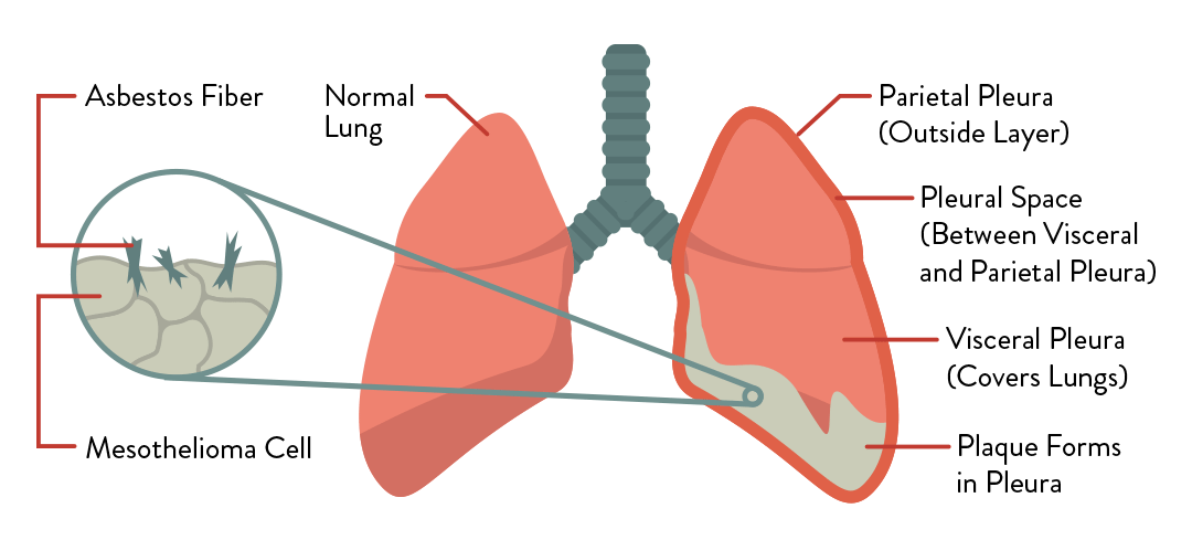 how long can you live with stage 4 lung cancer without chemo