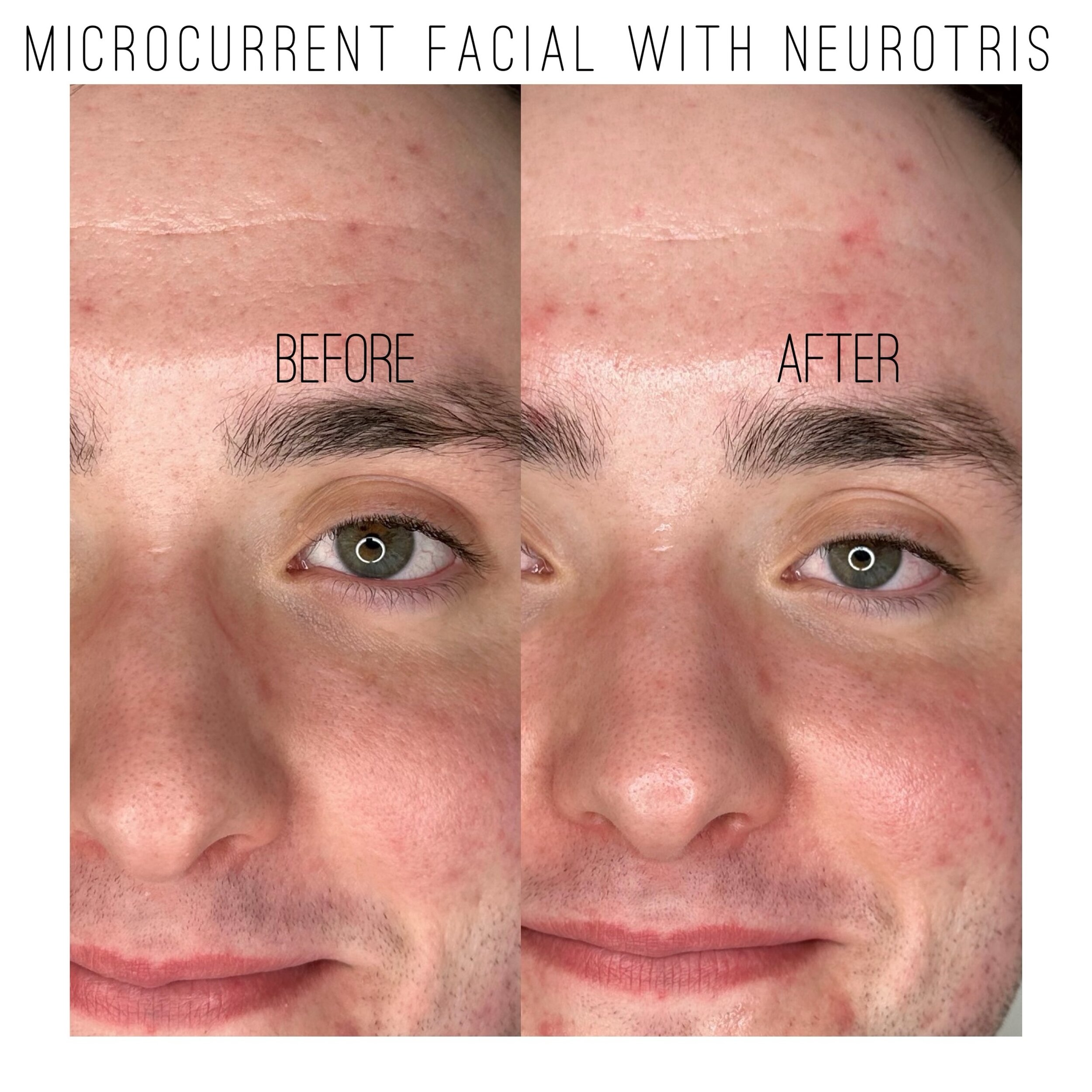 My client wanted me to work on his forehead wrinkles. This is just after one treatment. Microcurrent is a type of electrotherapy which delivers micro-currents that mimic the body&rsquo;s natural currents. When these micro-currents are delivered into 