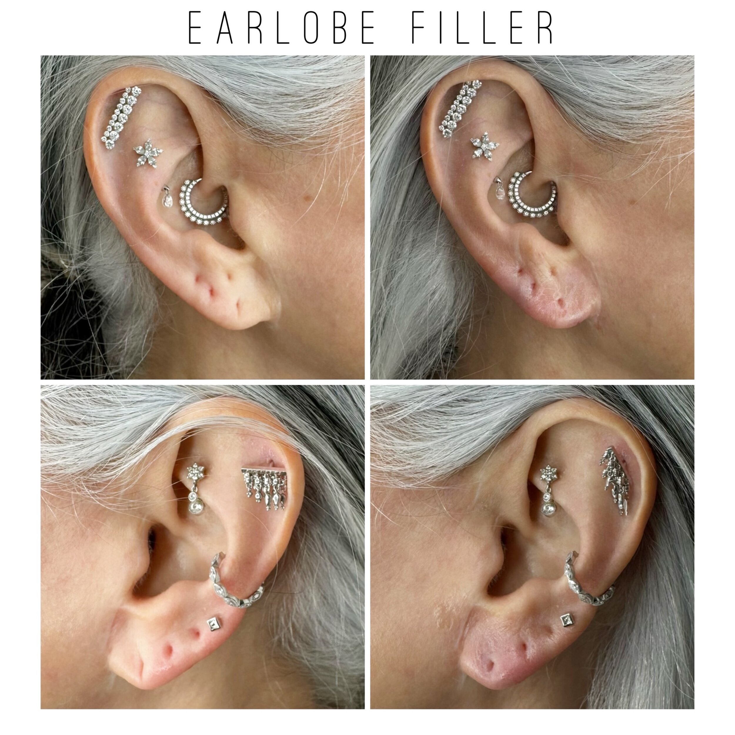 I betcha didn&rsquo;t know you could put filler in your earlobes!? Well, you can. 🤩 Transforming earlobes with precision and care! 💉✨ Say goodbye to sagging lobes and hello to a youthful, plump look with an earlobe filler treatment. Boost your conf