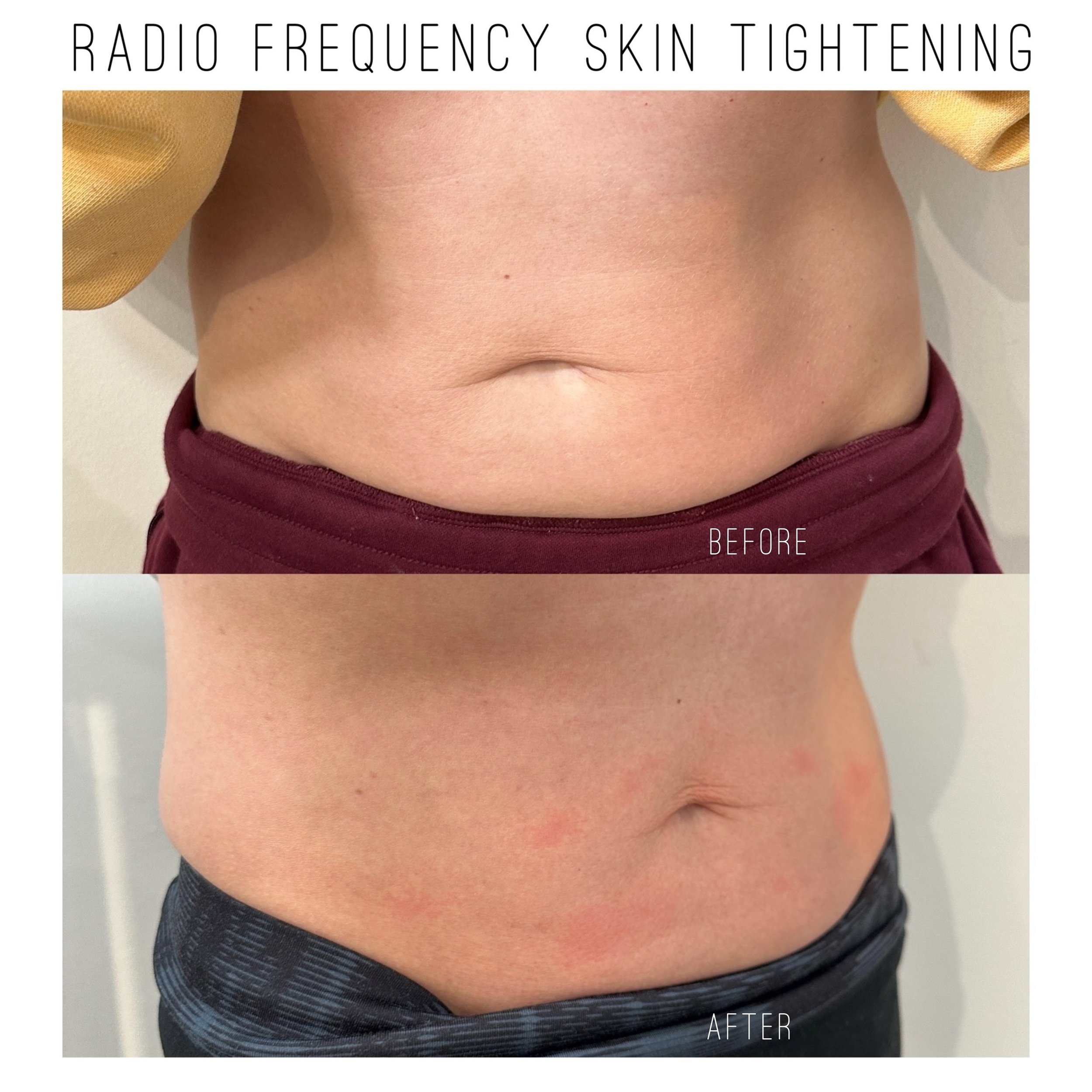 2 treatments ✨ Radio Frequency (RF) Therapy is an effective anti aging treatment that reverses the appearance of wrinkles, tightens sagging skin, and can even make crepey hands and necks appear firmer and more youthful.

Using radio waves, this treat