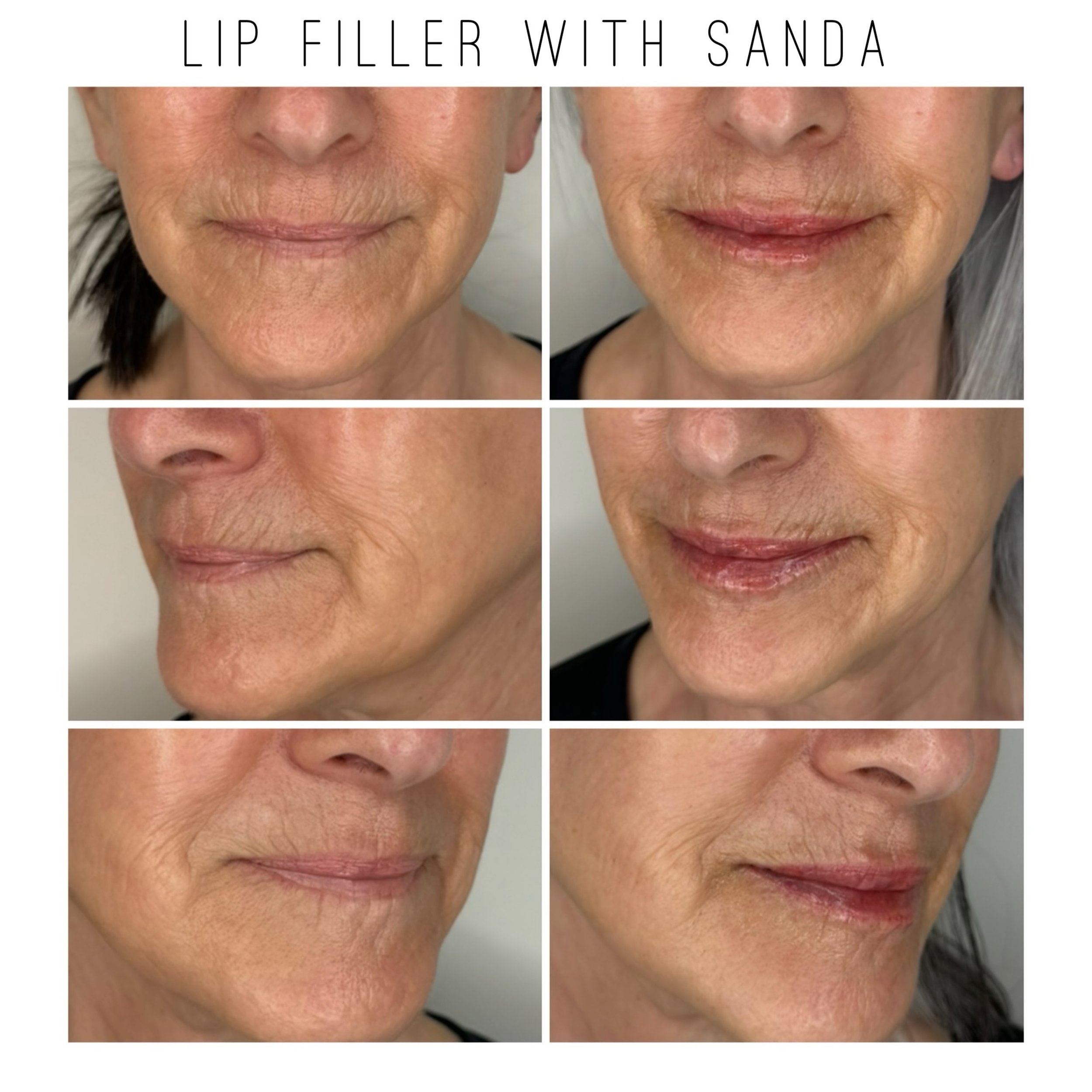 First images show before and two weeks after treatment. Second images show before and immediately after treatment.  Enhance your natural beauty with lip filler treatment! 💋 Say goodbye to dryness and hello to a subtle pout that hydrates your lips an