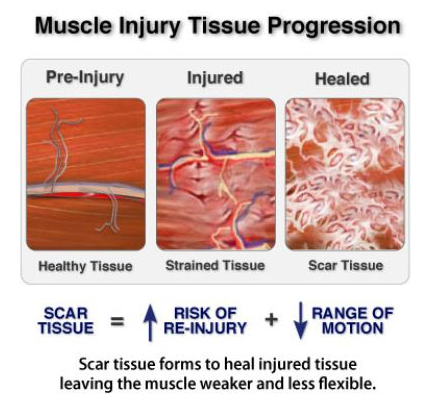 muscle-tissue-omaha-chirosport.png