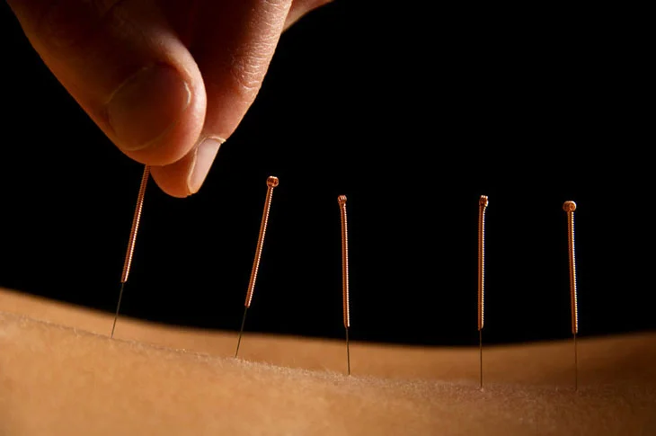 Acupunture-Therapy.jpg