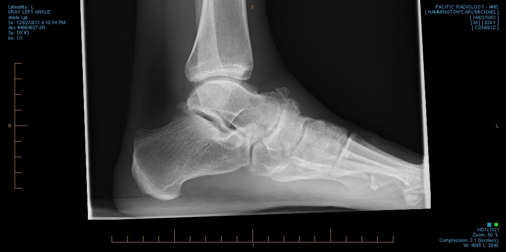 carl-foot.jpg