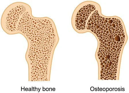 Does Weight Training Help With Bone Density?