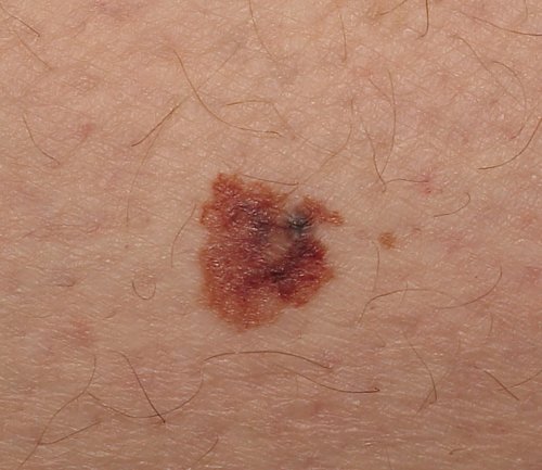 Overfladisk spredning av melanom