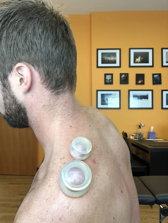 Cupping Suprascapular.jpg