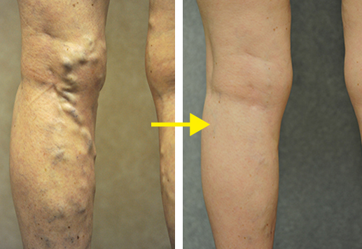 Varicose Veins - Treatment by Dr. Manuel Garcia | Lansing , Michigan — VeinsPlus