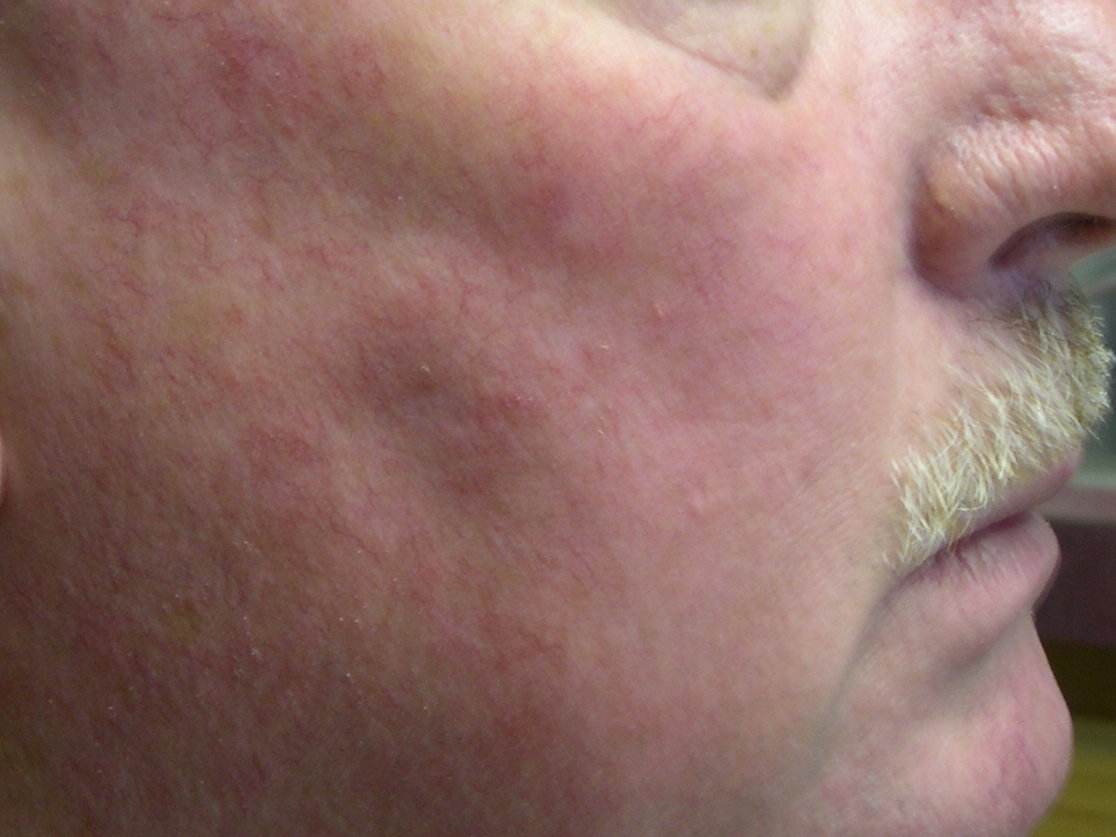 AFTER INTENSE PULSED LIGHT THERAPY