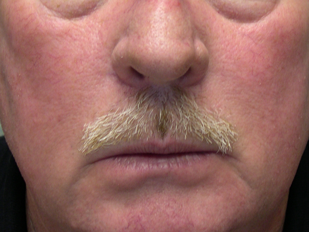 AFTER INTENSE PULSED LIGHT THERAPY
