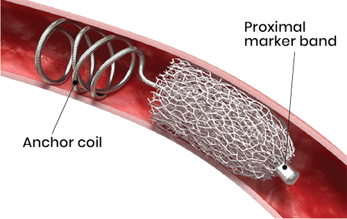 20190916_IMPEDE in Vessel with Labels.png