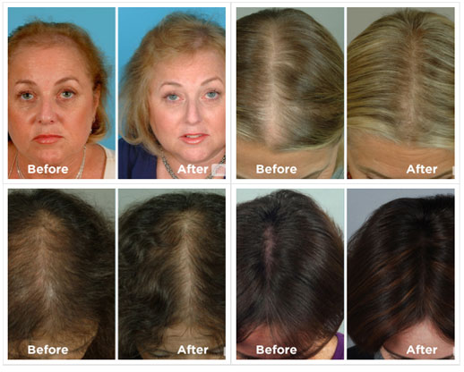 Laser Hair Loss Treatment Therapy - Minneapolis, St Paul